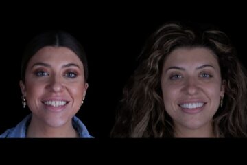Aparece una clienta que sonríe tras realizarse un tratamiento sobre carillas dentales