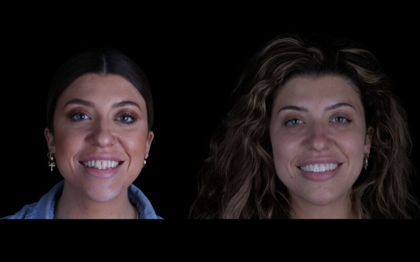 cuanto-duran-carillas-dentales cuanto duran las carillas estéticas