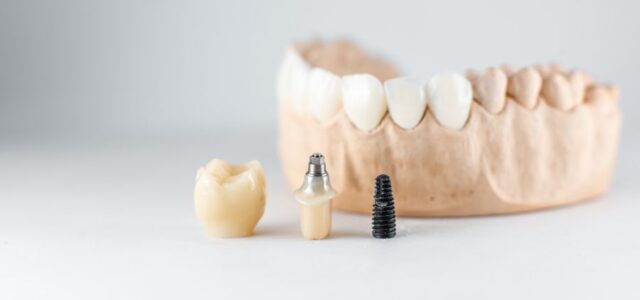 cuanto tiempo duran los implantes dentales