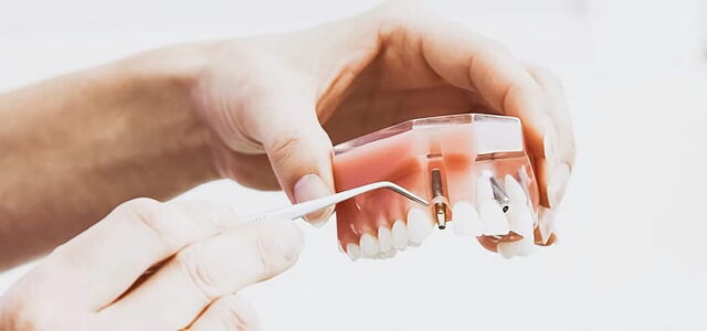 Cuánto se tarda en poner un implante dental Implantes dentales