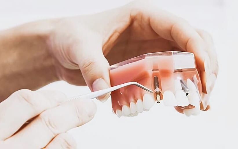 Cuánto se tarda en poner un implante dental Implantes dentales