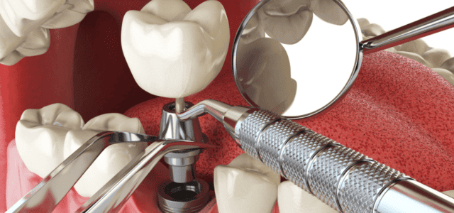 Cuello o pilar de un implante dental