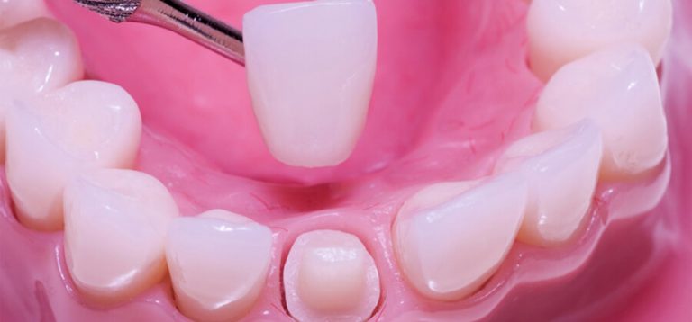 Coronas De Zirconio Qu Son Ventajas Y Precio Ferrus Bratos coronas-de-zirconio-qu-son-ventajas-y-precio-ferrus-bratos