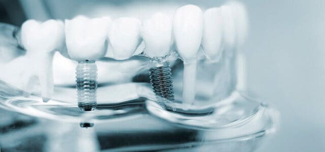 Implantes dentales