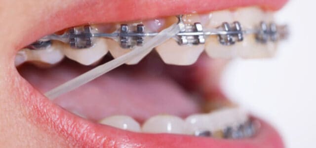 4 consejos para deportistas que llevan ortodoncia con brackets