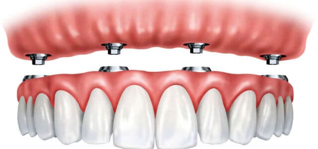 Dentadura postiza de poner y quitar ¿Cuánto cuesta?