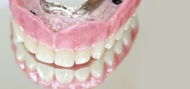 Todos los implantes en un día Dentadura fija en 24 horas