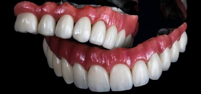 Dentadura fija sobre 4 implantes