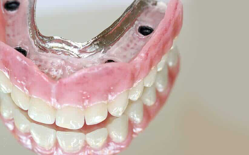 dentadura postiza completa