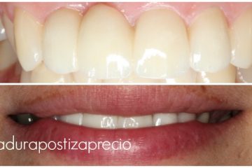 Precio de una dentadura completa fija