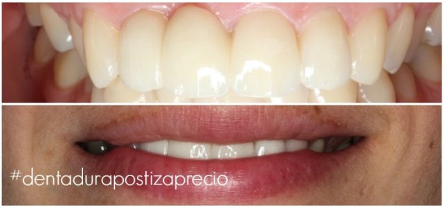 2018 precio dentadura postiza