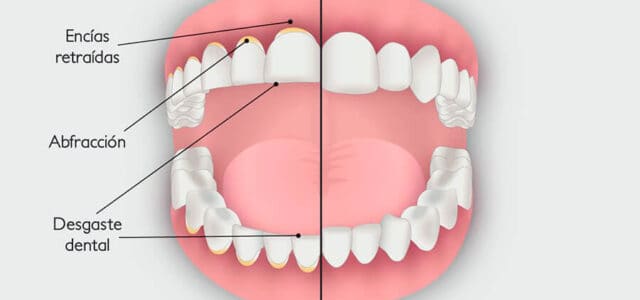 desgaste dental pro bruxismo