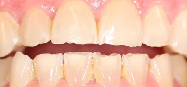 Dientes desgastados por bulimia