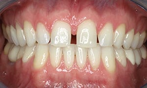 Diastema - Antes