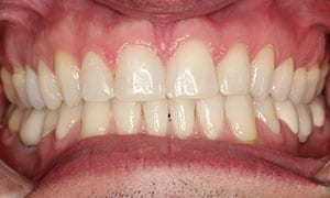 Diastema - Después