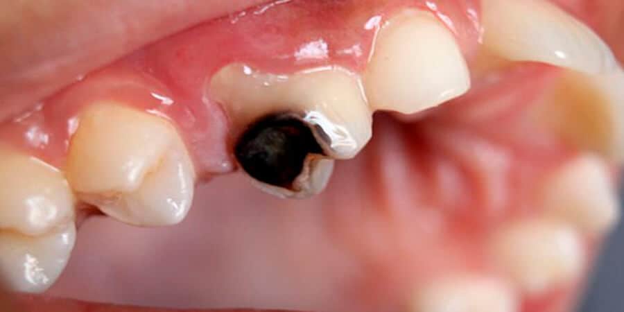 Diente podrido: ¿cómo se puede tratar? | Ferrus&Bratos