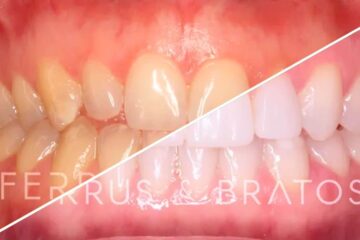 solución dientes amarillos