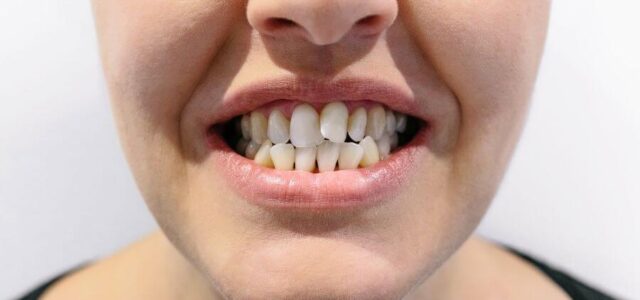 Apiñamiento dental moderado