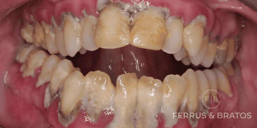 caso de piorrea grave