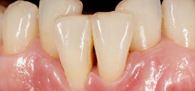 Apiñamiento dental severo