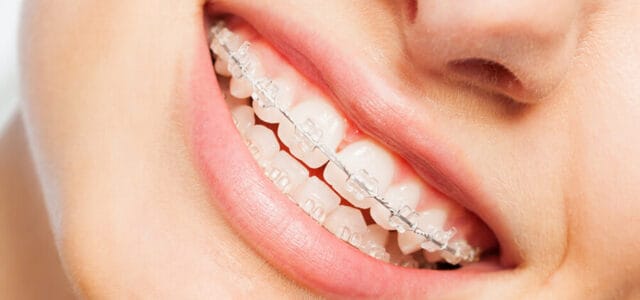 Separación de dientes