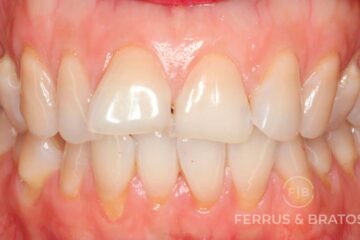 Paciente adulto con dientes torcidos