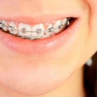 Tratamiento con ortodoncia