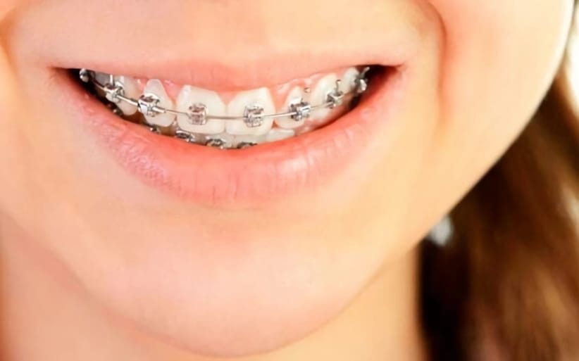 Soluciones para dientes torcidos Tratamiento con ortodoncia