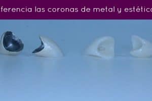 protesis dientes ceramicas
