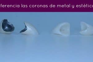 protesis dientes ceramicas