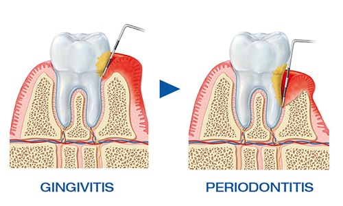 Cuales son los tipos de periodontitis