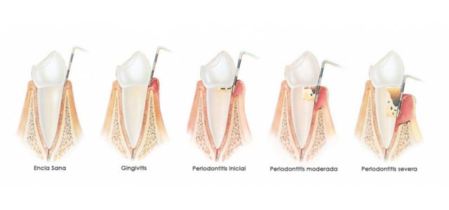 Enfermedades periodontales: gingivitis y piorrea