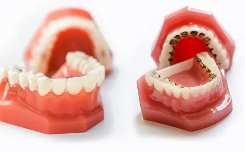 Ortodoncia invisible Invisalign e Incognito