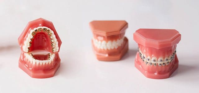 Donde puedo ponerme brackets baratos
