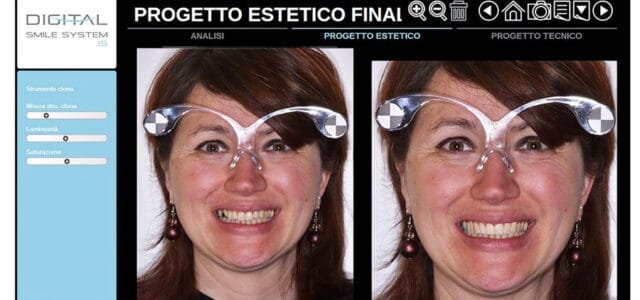 Simulación de diseño de sonrisa