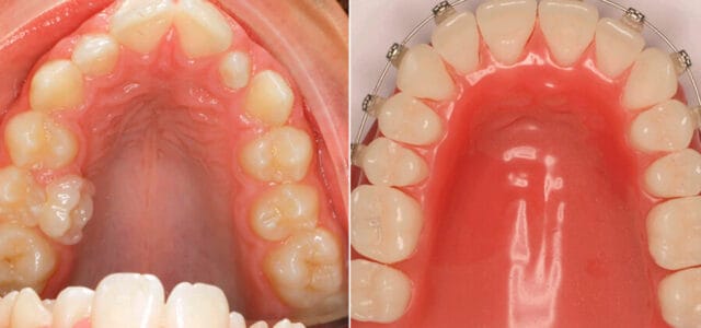 Disyuntor dental antes y después