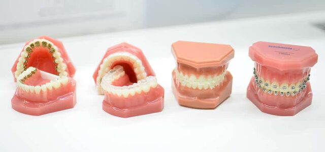 Precio de los brackets Cuánto cuestan los brackets