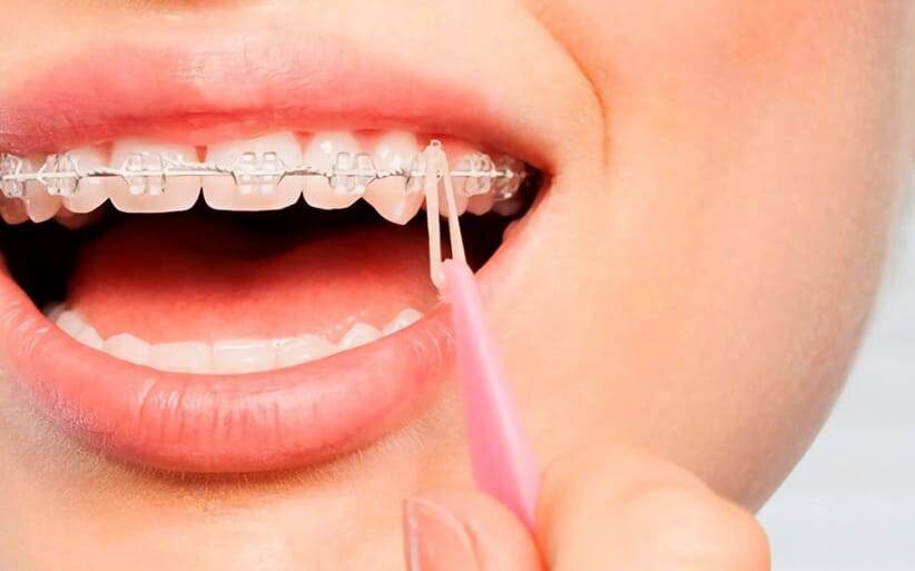 Gomas de brackets ¿Para qué sirven en ortodoncia?