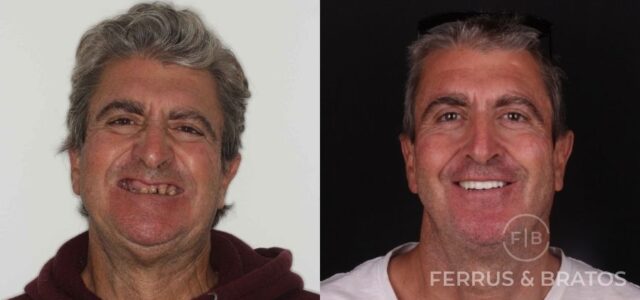 Elevación de seno maxilar para implantes dentales