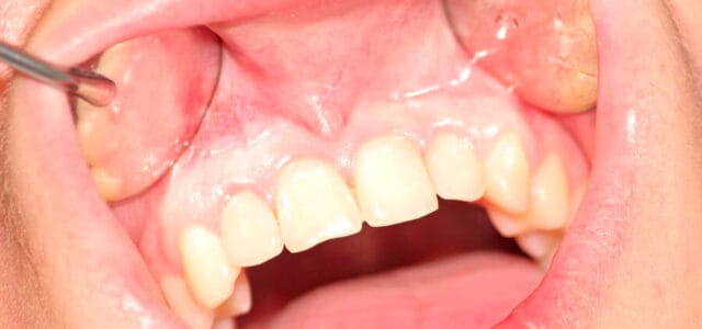 entrada Generalizar fatiga Encías blancas: causas y tratamiento | Clínica dental Ferrus & Bratos