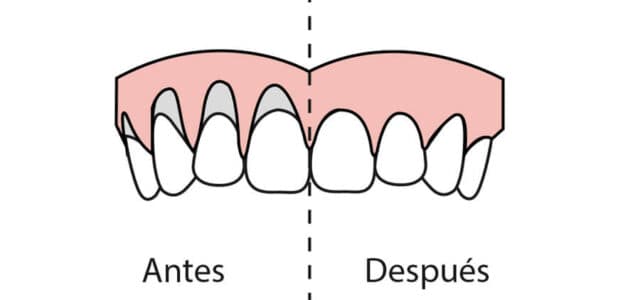 Antes y después del injerto de encías