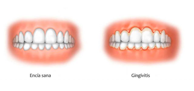 La gingivitis irrita la encía