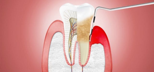 Imagen de enfermedad periodontal
