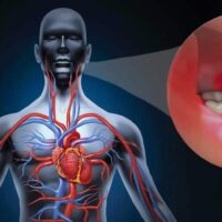 Periodontitis y infarto de miocardio