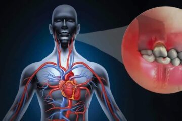 Periodontitis y infarto de miocardio