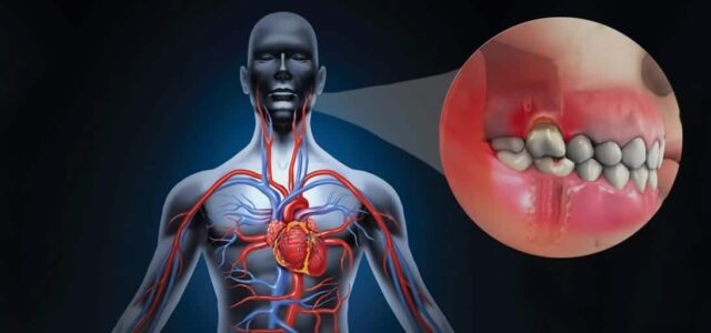 Enfermedades periodontales y infarto Periodontitis y infarto de miocardio