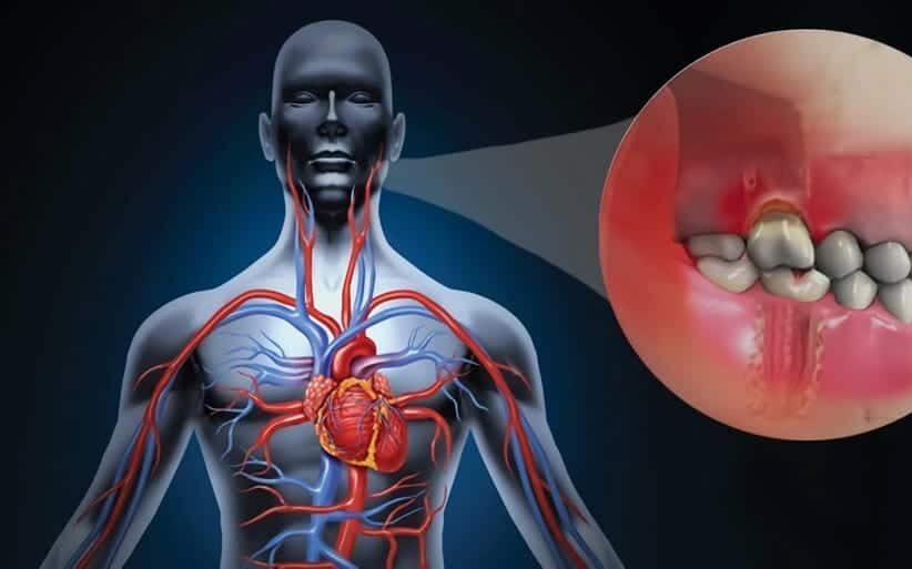 Periodontitis y infarto de miocardio