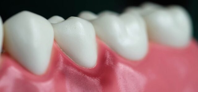Las encías retraídas pueden provocar gingivitis