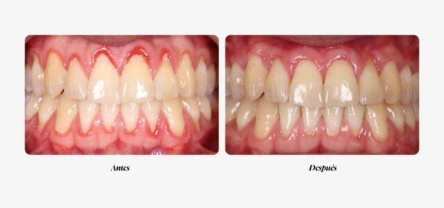 Aparece una foto de un paciente con encías retraidas antes y después del injerto
