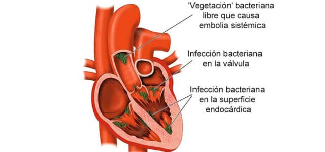 Infección en el corazón